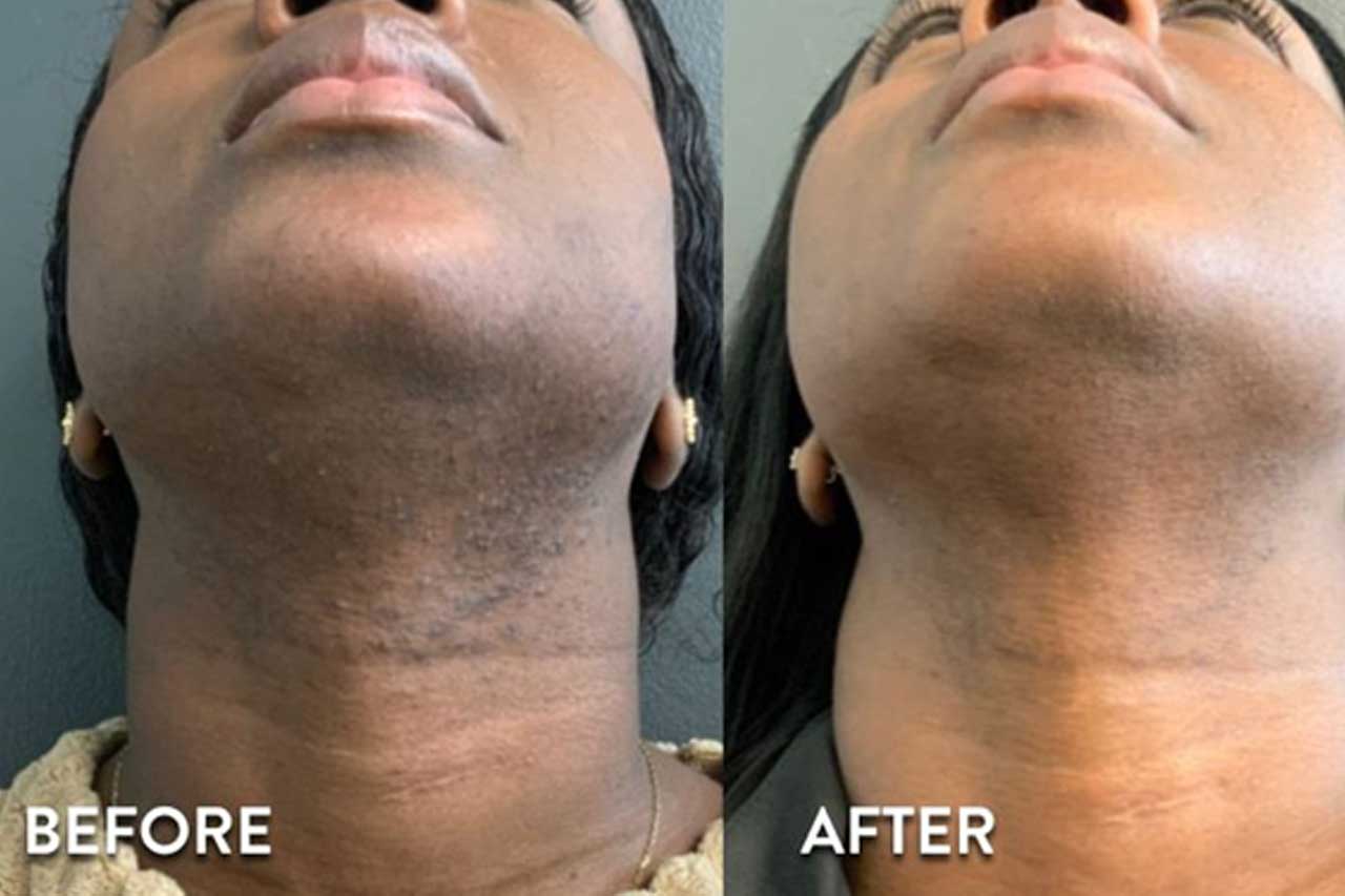 Laser hair removal before and after underarm results
