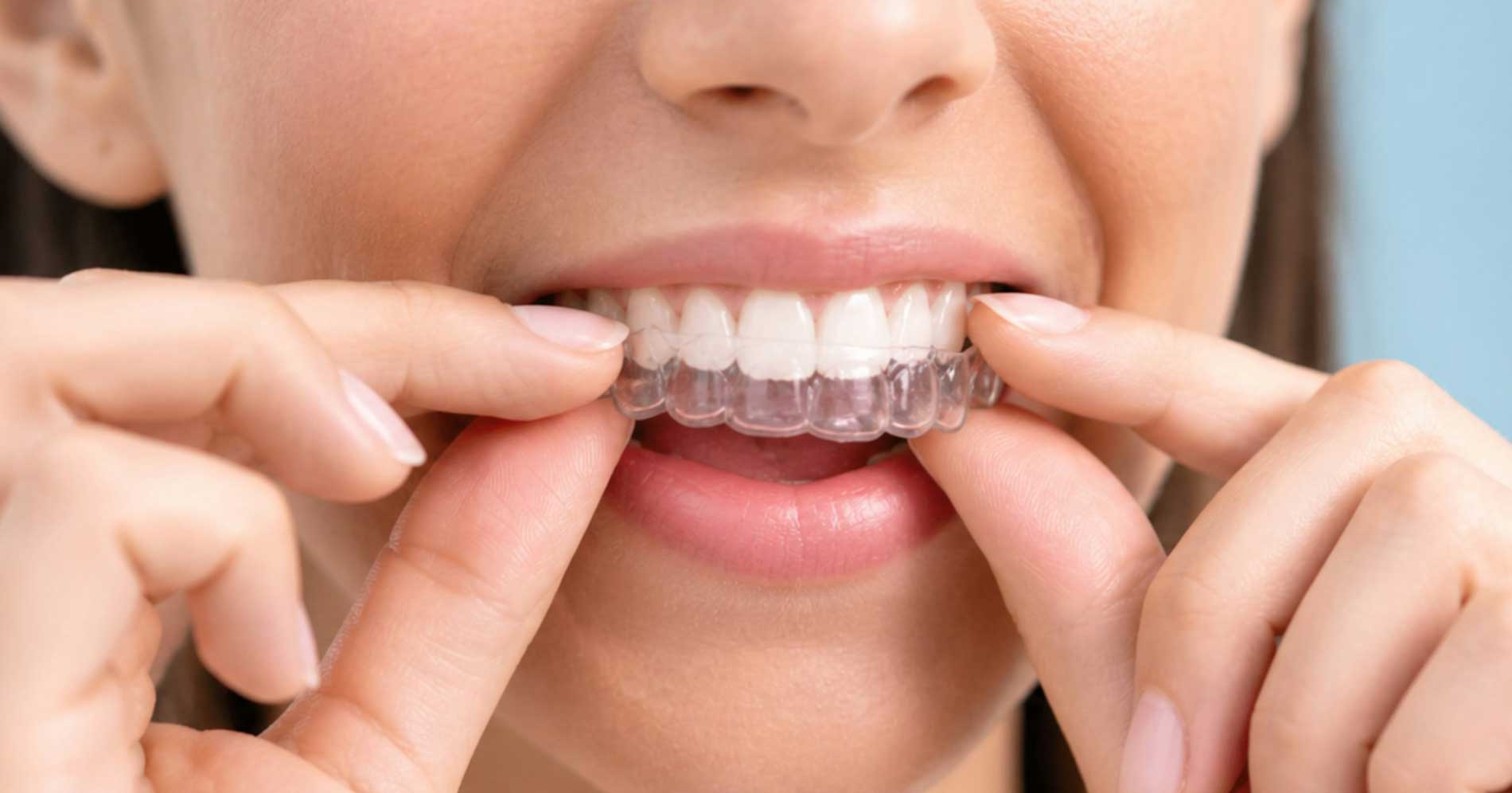 Invisalign clear aligners