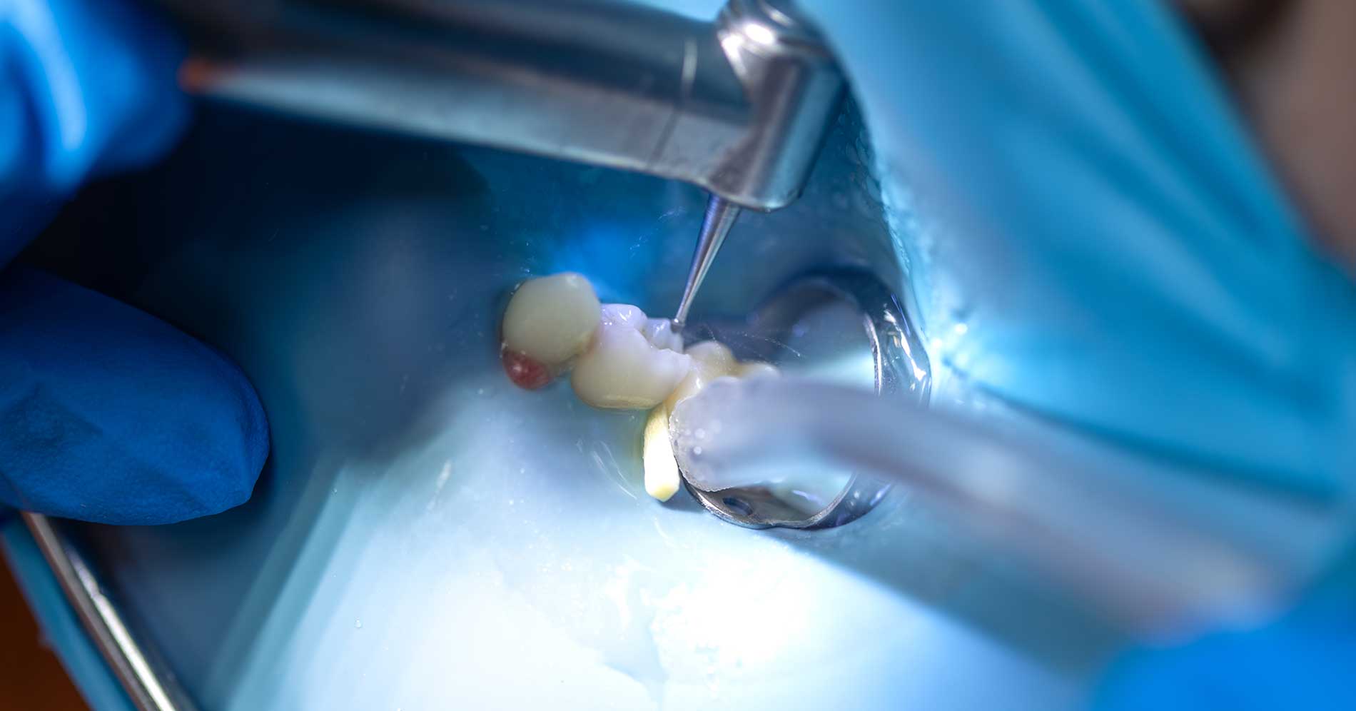 Root canal dental model